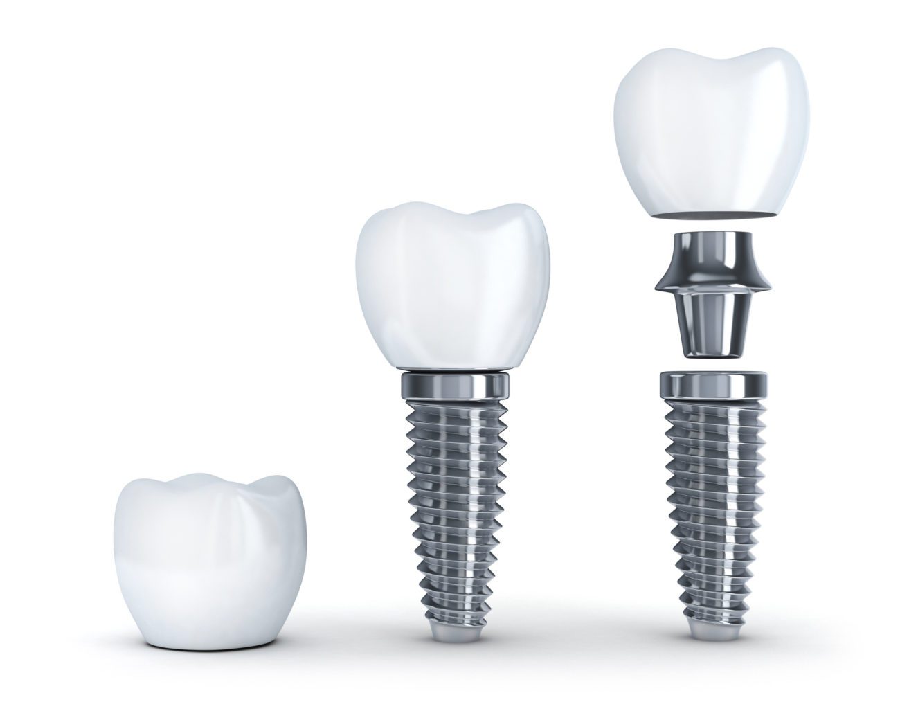 Dental Implants in Calgary AB  Replace Missing Teeth