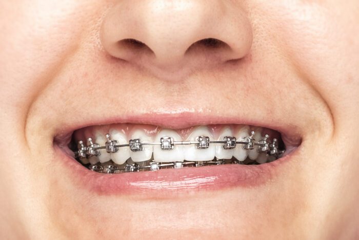 Invisalign and metal braces for adults in Calgary, AB, could help adjust your bite and improve your smile.